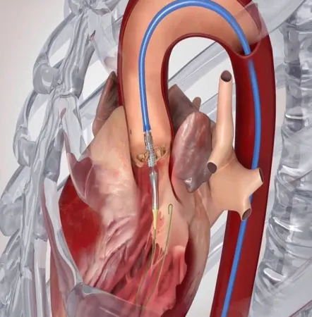 Heart Valve Surgery image 2